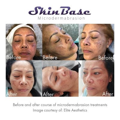before and after pigmentation