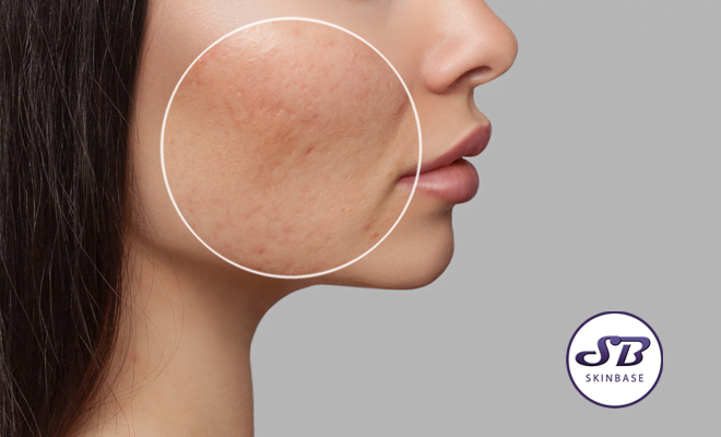 acne scarring