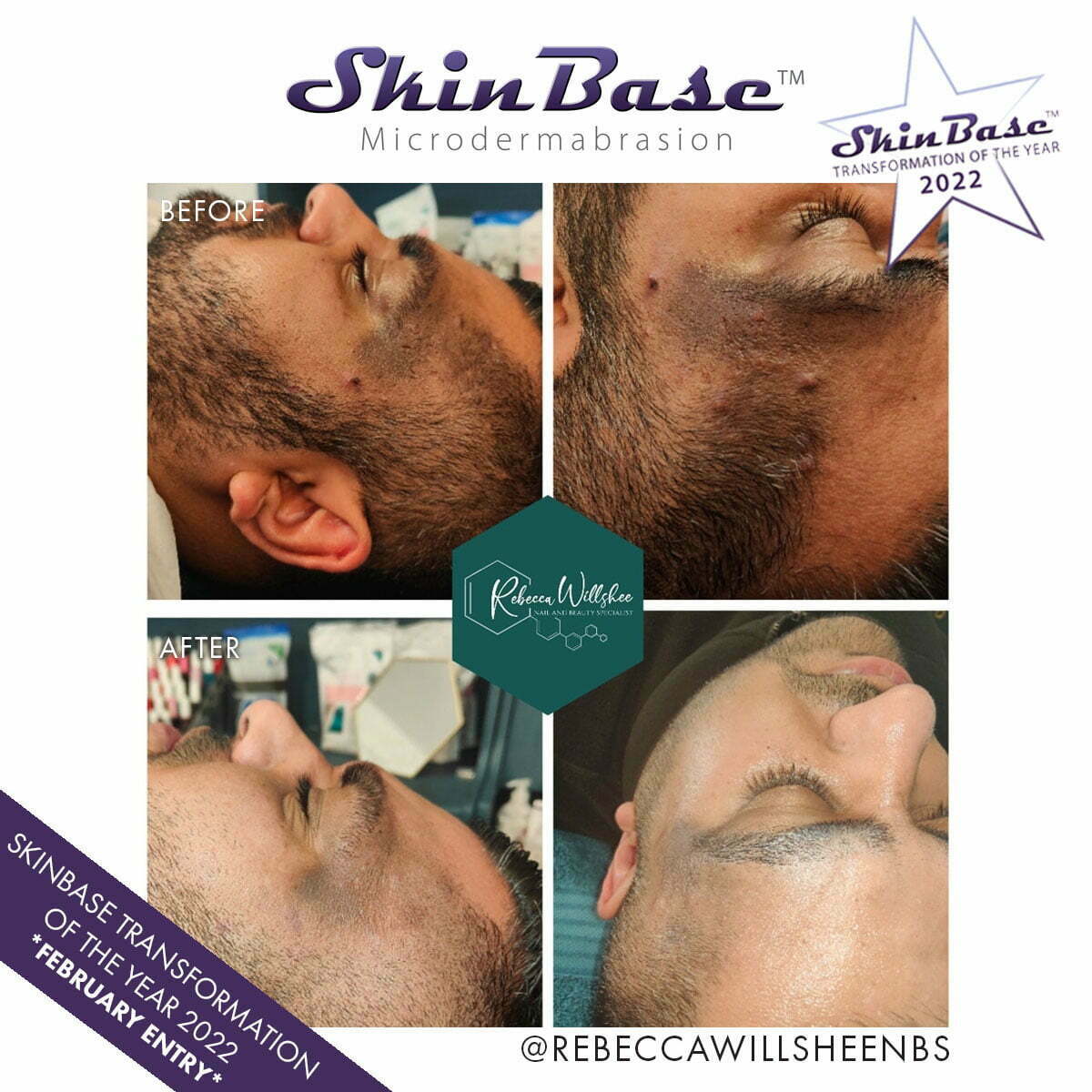 microdermabrasion before and after