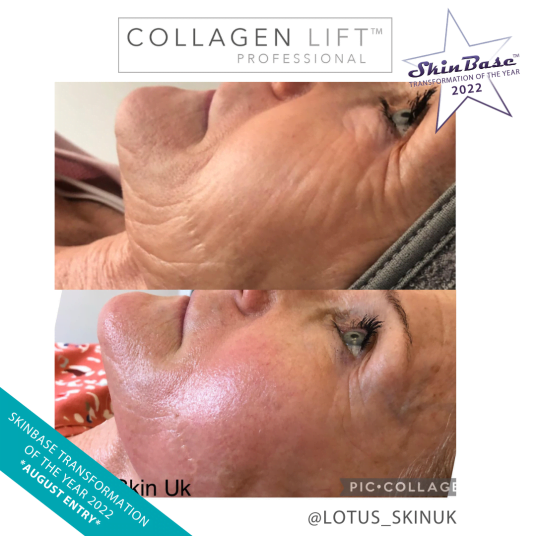 LOTUSSKINUK LOTUSSKINUK Collagen Lift facial Transformation