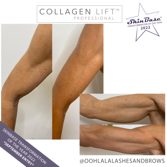 September skincare arm transformation September skincare arm transformation