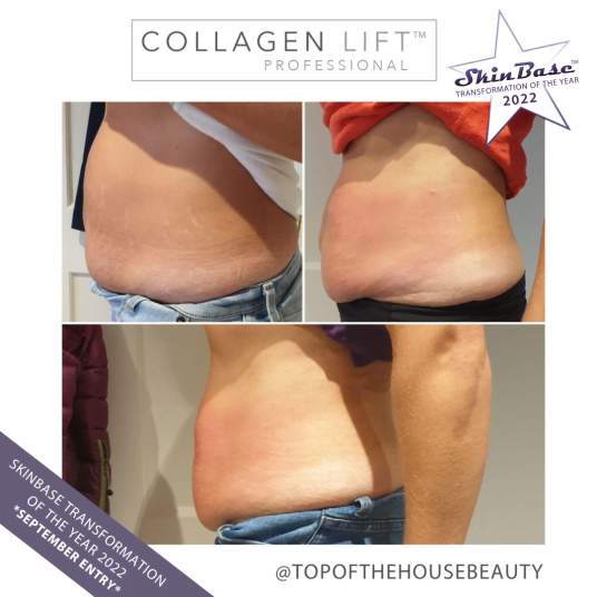 post-pregnancy skin concerns