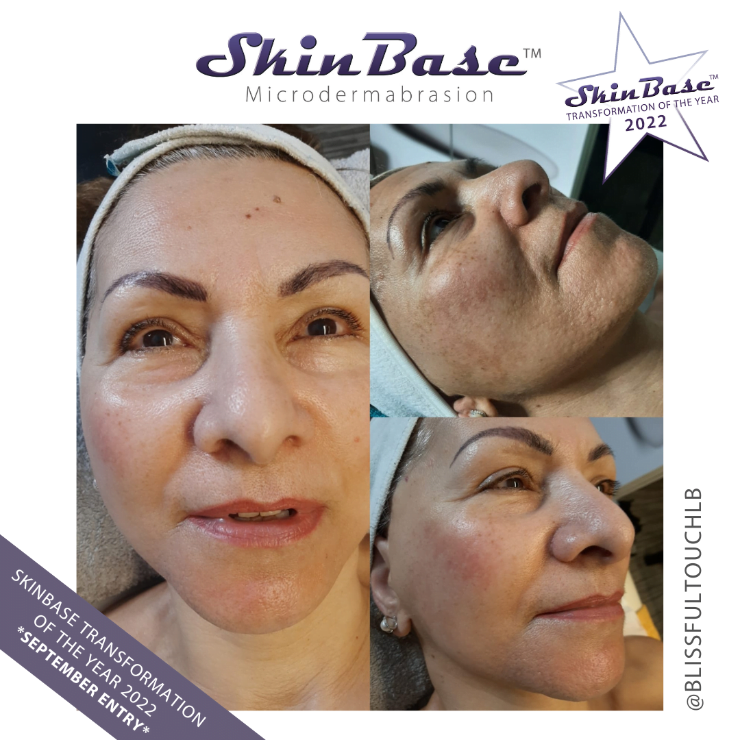 BLISSFULTOUCH MELASMA