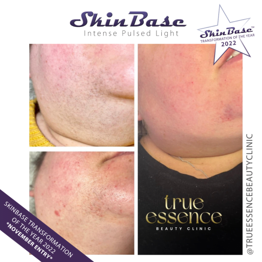 TRUEESSENCEBEAUTYCLINIC November skin