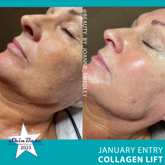 COLLAGEN LIFT TRANSFORMATIONS BEAUTYBYJOANNESMEDLEY4 COLLAGEN LIFT TRANSFORMATIONS BEAUTYBYJOANNESMEDLEY