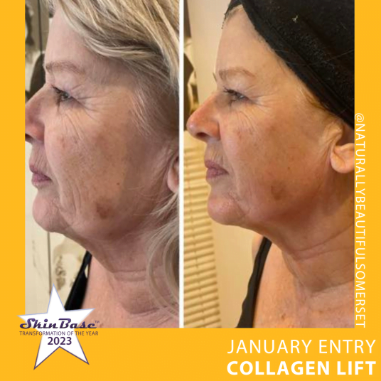 COLLAGEN LIFT TRANSFORMATIONS NATURALLYBEAUTIFUL COLLAGEN LIFT TRANSFORMATIONS NATURALLYBEAUTIFUL