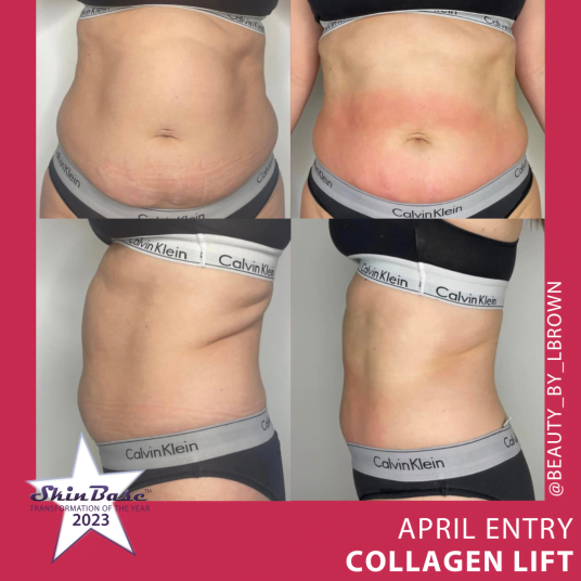 April transformation entries radio frequency tummy transformation 