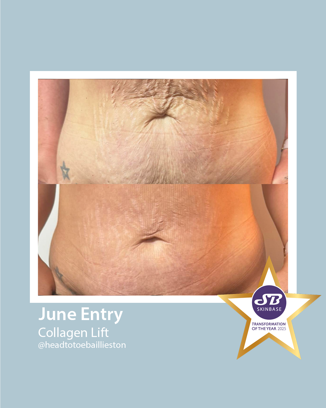 June Head to Toe Baillieston Collagen Lift
