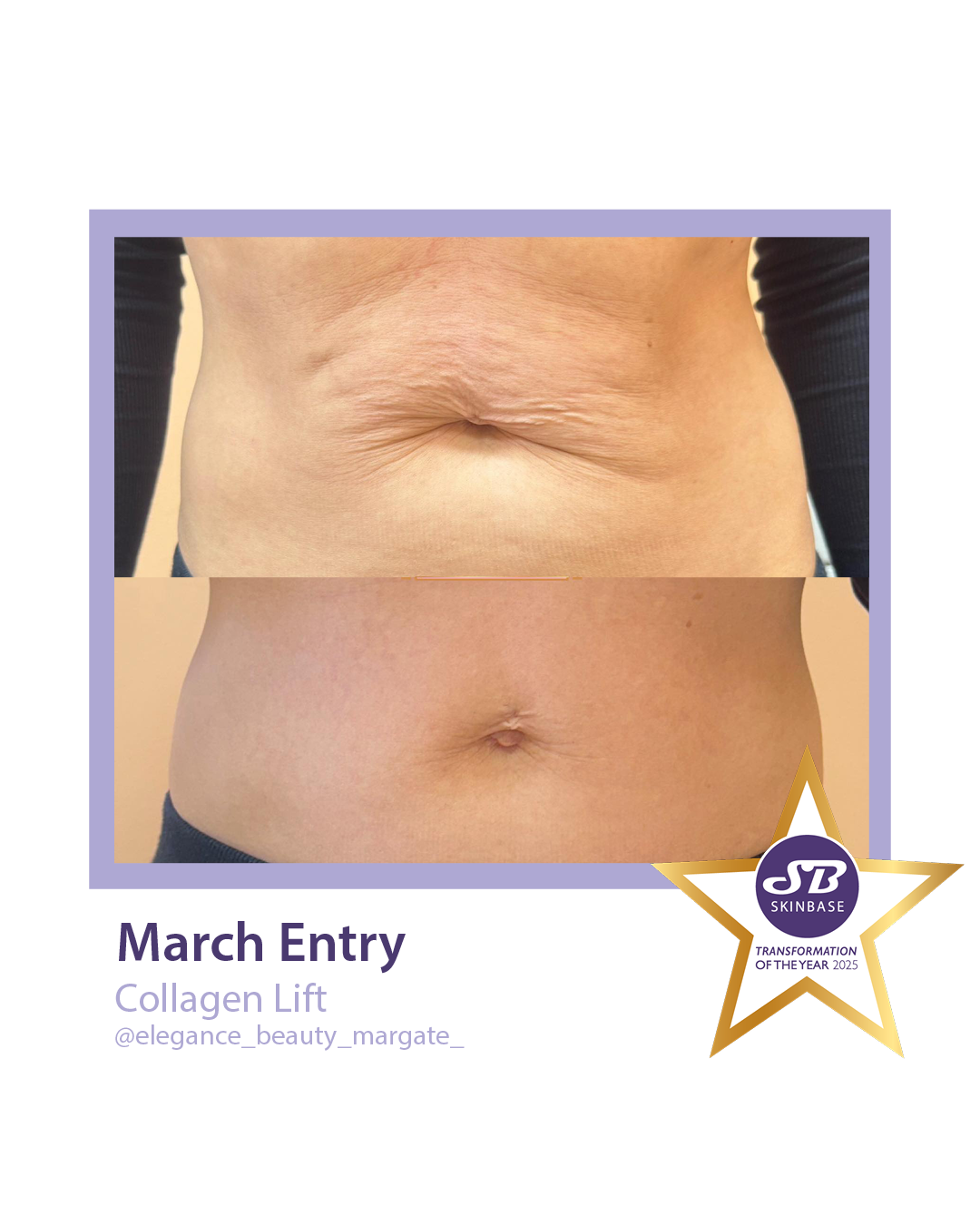March Elegance Beauty Margate Collagen Lift