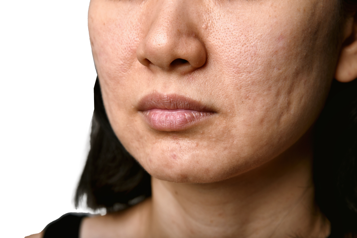 acne scarring