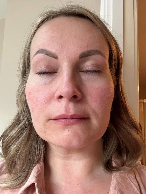 beforeandaftermicrodermabrasion