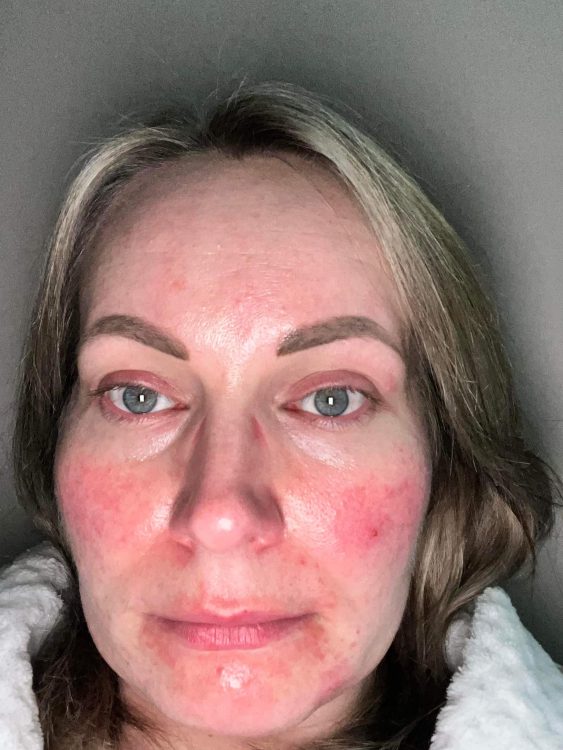 beforeandaftermicrodermabrasion