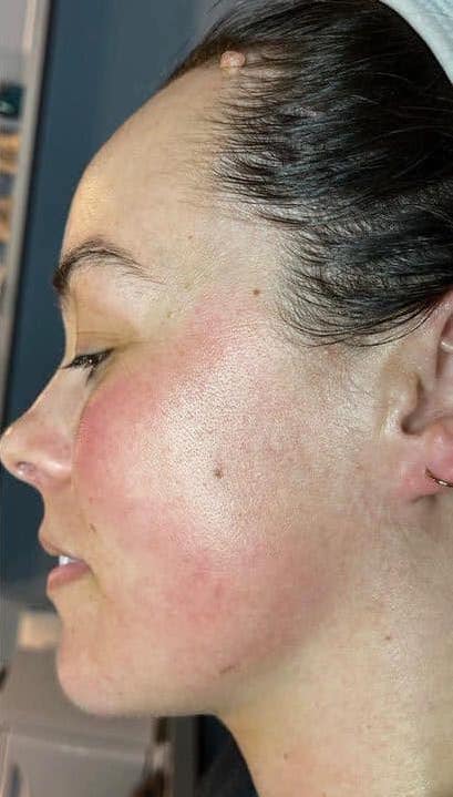 beforeandaftercollagenlift