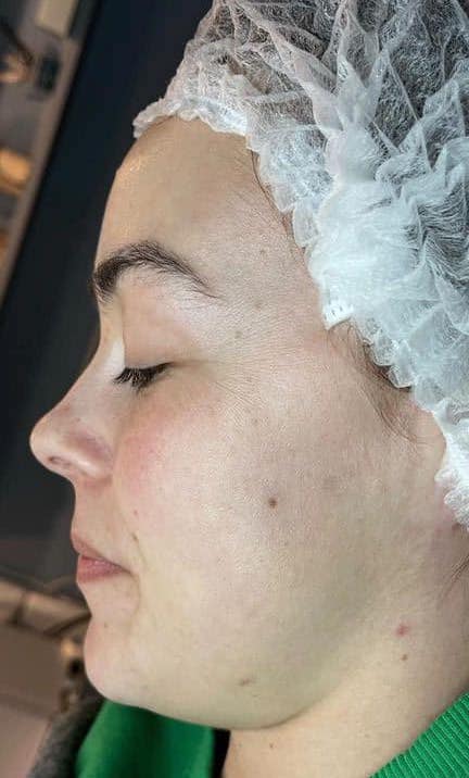 beforeandaftercollagenlift