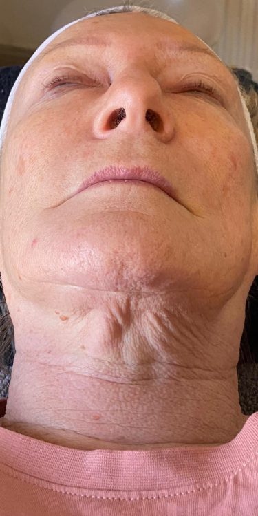 beforeandaftercollagenlift