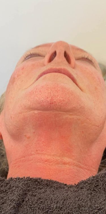 beforeandaftercollagenlift