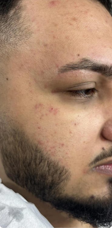 beforeandaftermicrodermabrasion