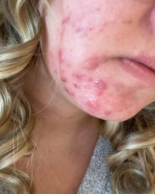 beforeandaftermicrodermabrasion