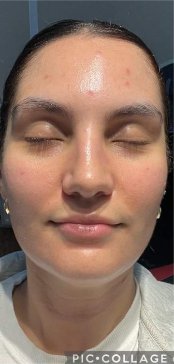 beforeandaftermicrodermabrasion