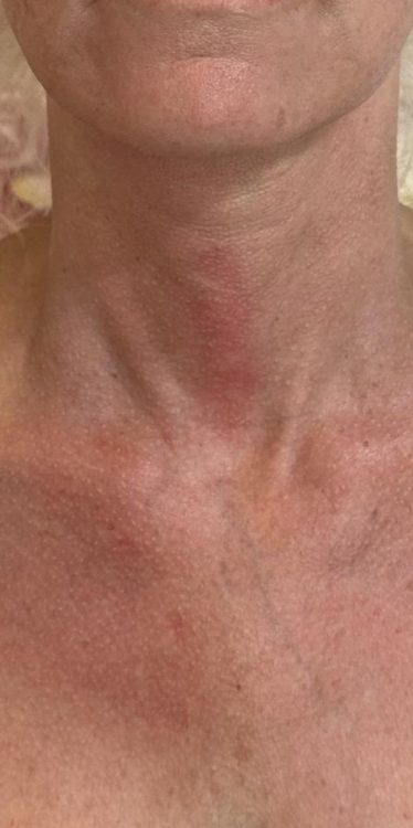 beforeandaftercollagenlift