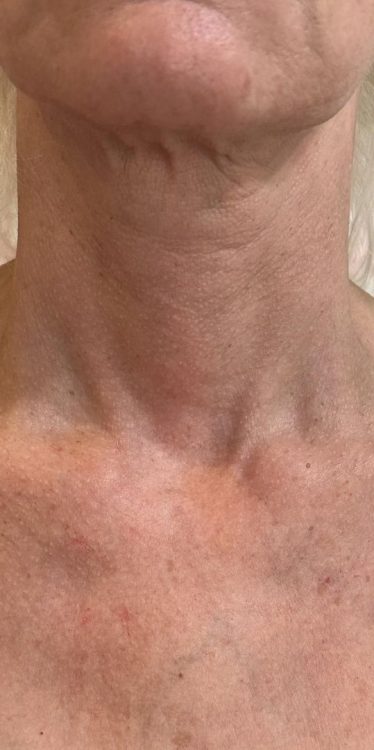 beforeandaftercollagenlift