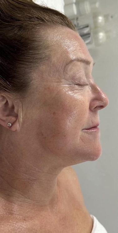 beforeandaftercollagenlift