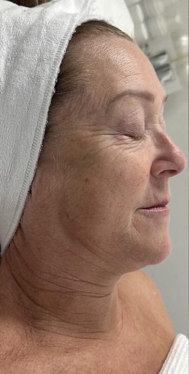 beforeandaftercollagenlift