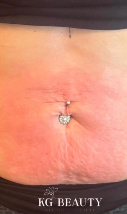 beforeandaftercollagenlift