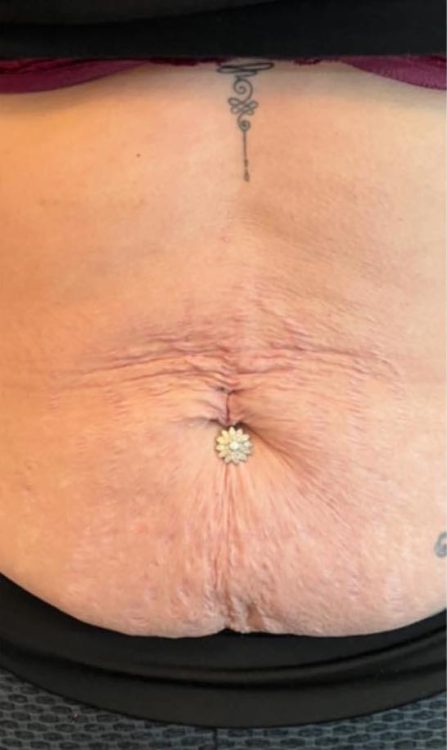 beforeandaftercollagenlift