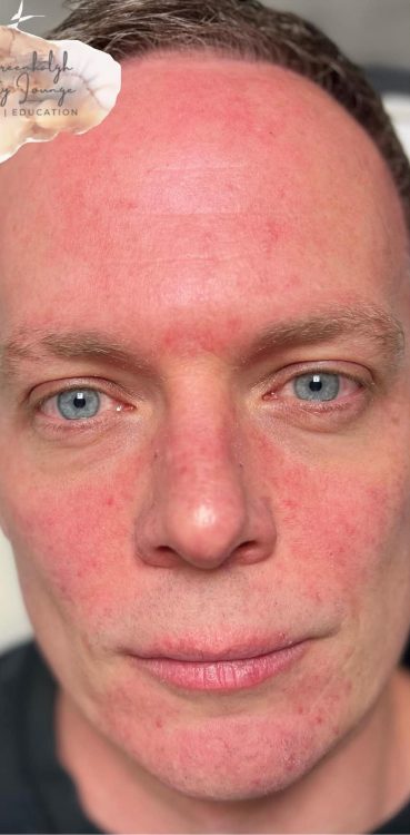beforeandafteripl