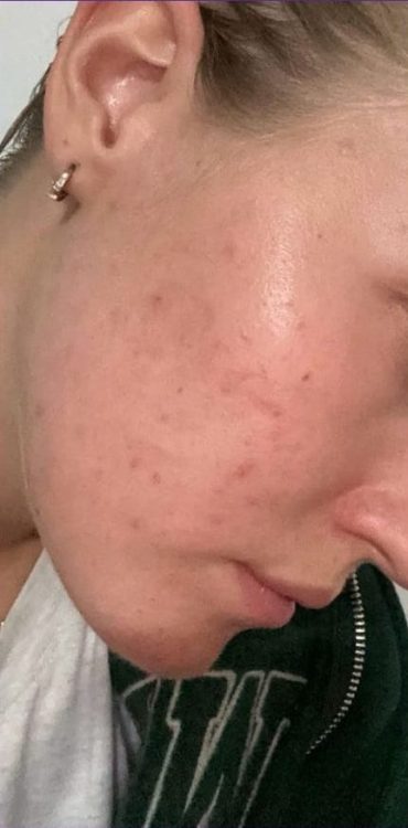 beforeandaftermicrodermabrasion