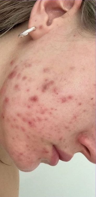 beforeandaftermicrodermabrasion