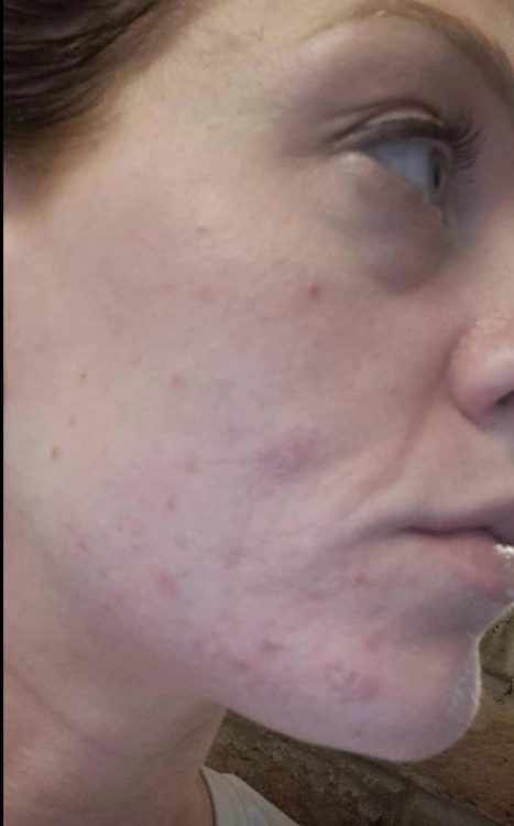 beforeandaftermicrodermabrasion