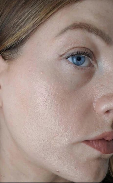 beforeandaftermicrodermabrasion