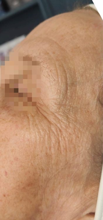 beforeandaftercollagenlift