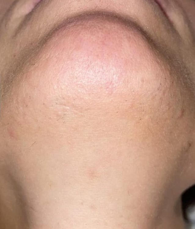 beforeandafteripl