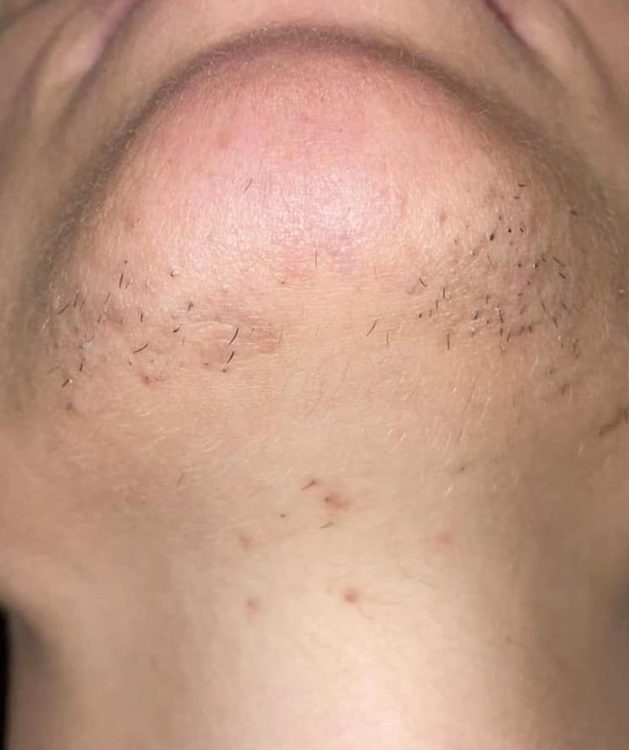 beforeandafteripl