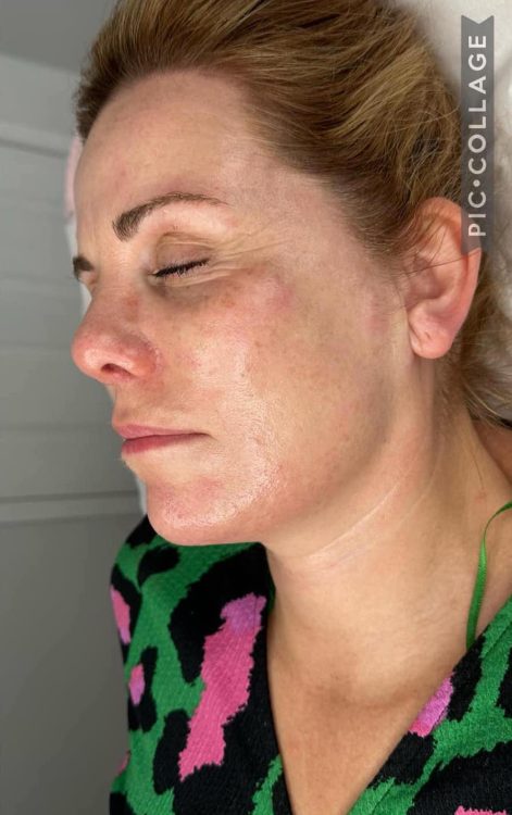 beforeandaftercollagenlift