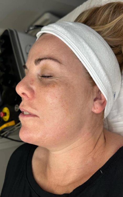 beforeandaftercollagenlift