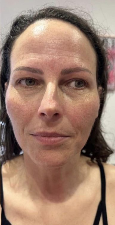 beforeandaftercollagenlift