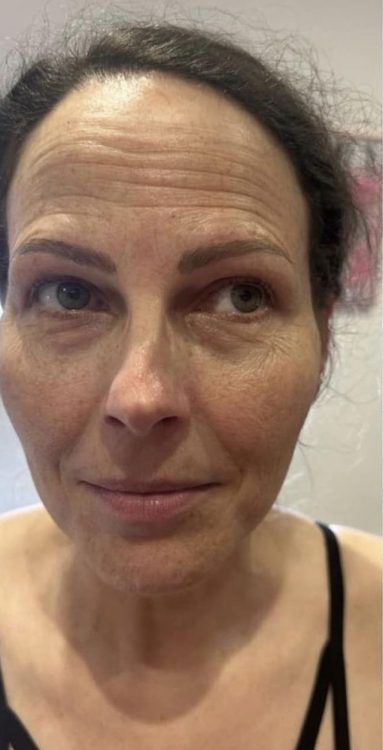 beforeandaftercollagenlift