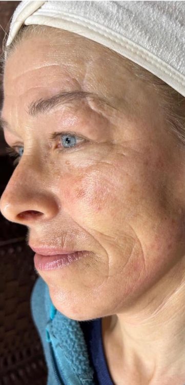 beforeandaftercollagenlift
