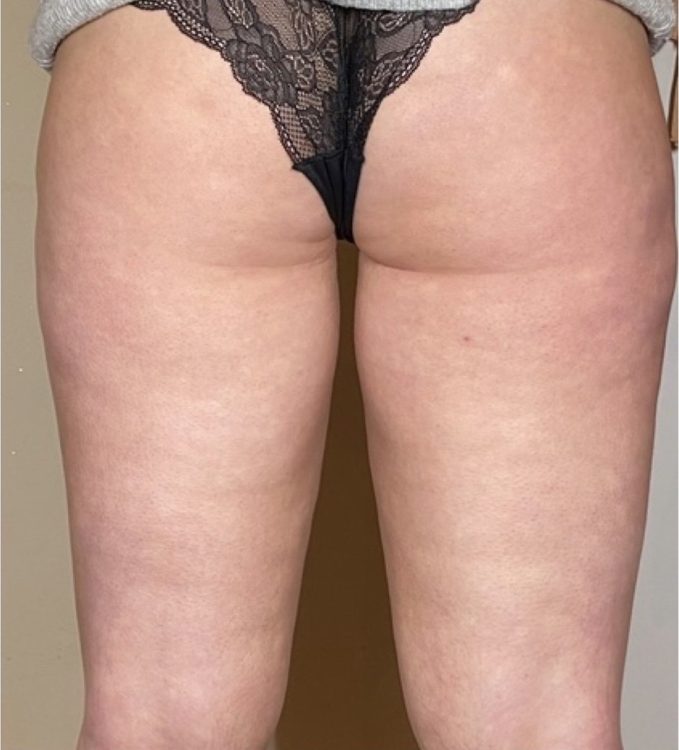 beforeandaftermicrodermabrasion