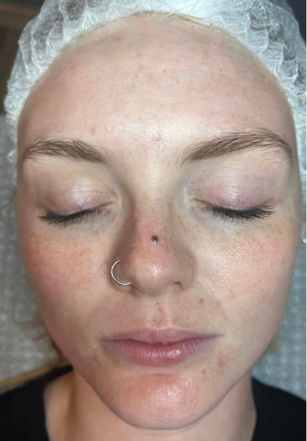 beforeandaftermicrodermabrasion