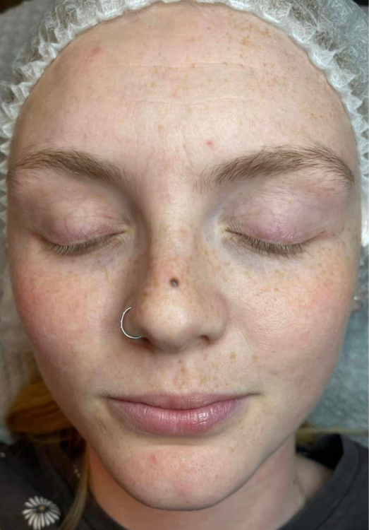 beforeandaftermicrodermabrasion