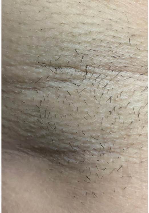 beforeandafteripl