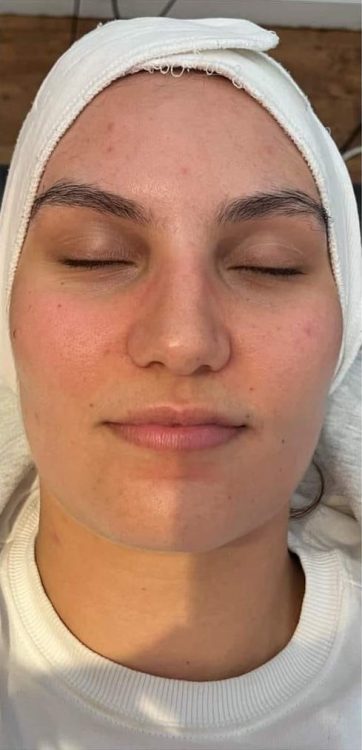 beforeandaftermicrodermabrasion