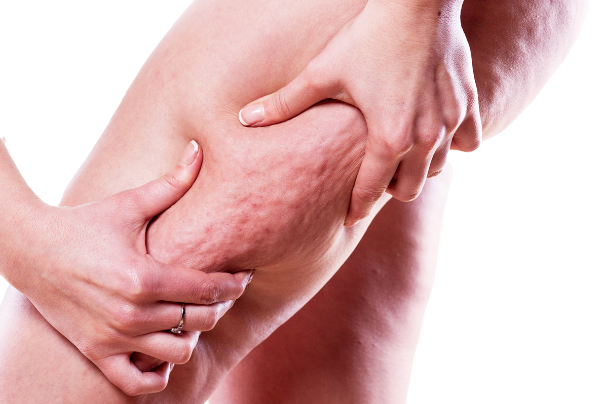 cellulite