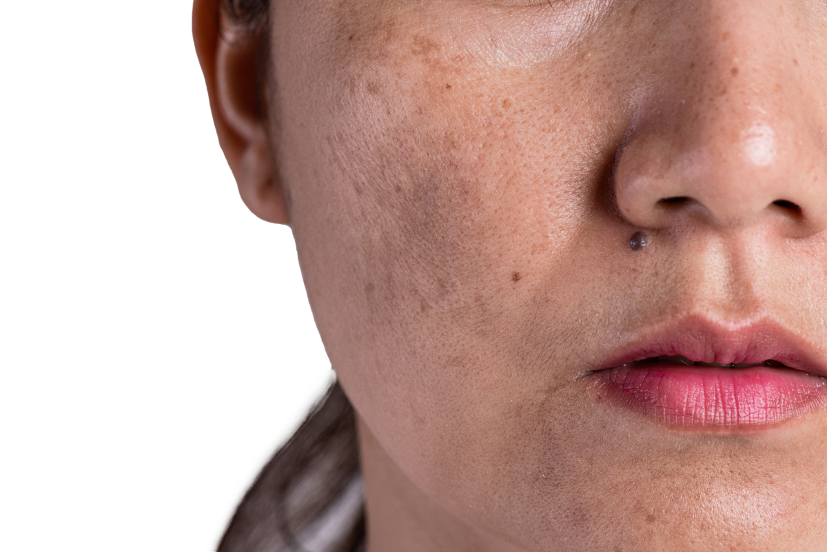 pigmentation