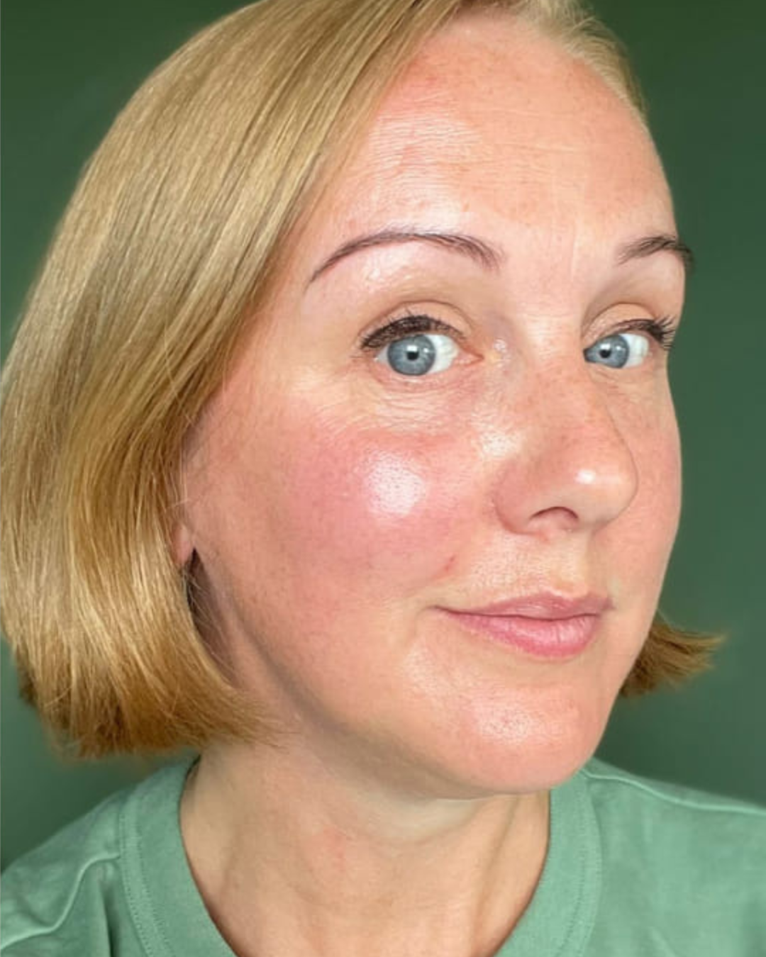 beforeandaftercollagenlift